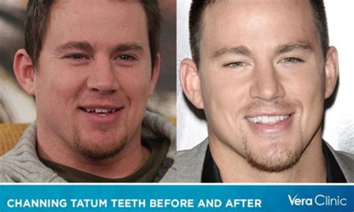 Channing Tatum Teeth Before and After: A Complete Transformation Journey