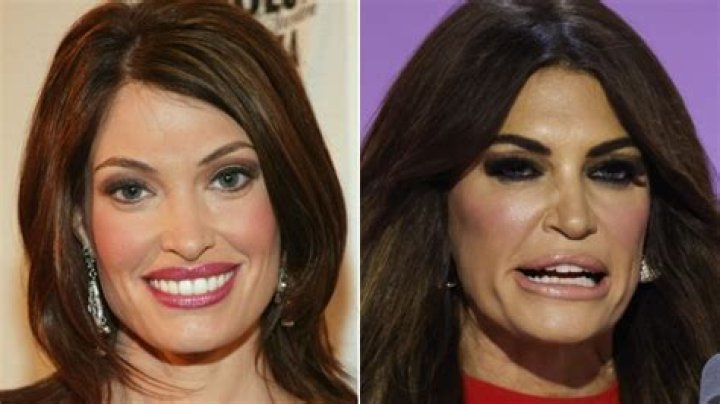 Revealing the Transformation: A Look at Kimberly Guilfoyle's Plastic Surgery Photos