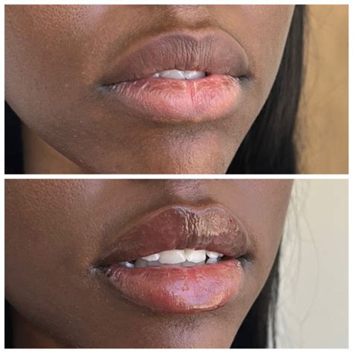 Suni Lee Lip Fillers: Everything You Need to Know