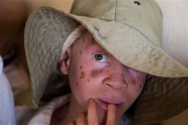 The Palest Person in the World: Exploring Albinism and Its Impact on Life